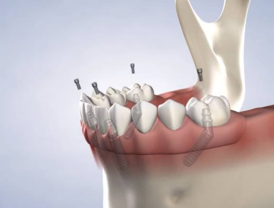 What is full arch restoration?